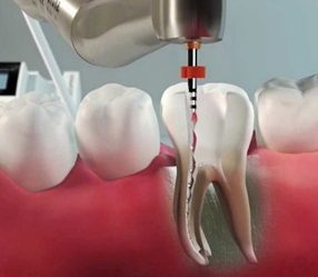 Endodontia – Tratamento de Canal