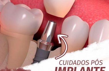 Cuidados Pós Implantes