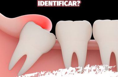 Pericoronarite o que é, e como Identificar.