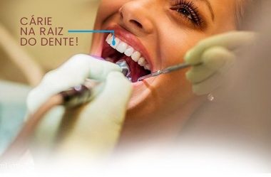 Cárie na raiz do dente!