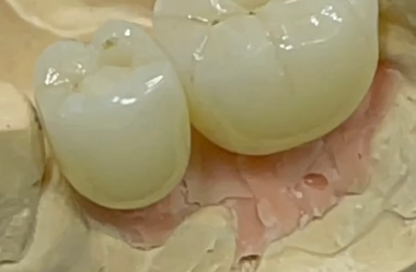 Implantes e Coroas Cerâmicas sobre Implantes