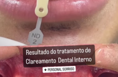 Clareamento Dental