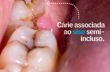 Cirurgia dos Dentes Semi-Inclusos (Sisos)