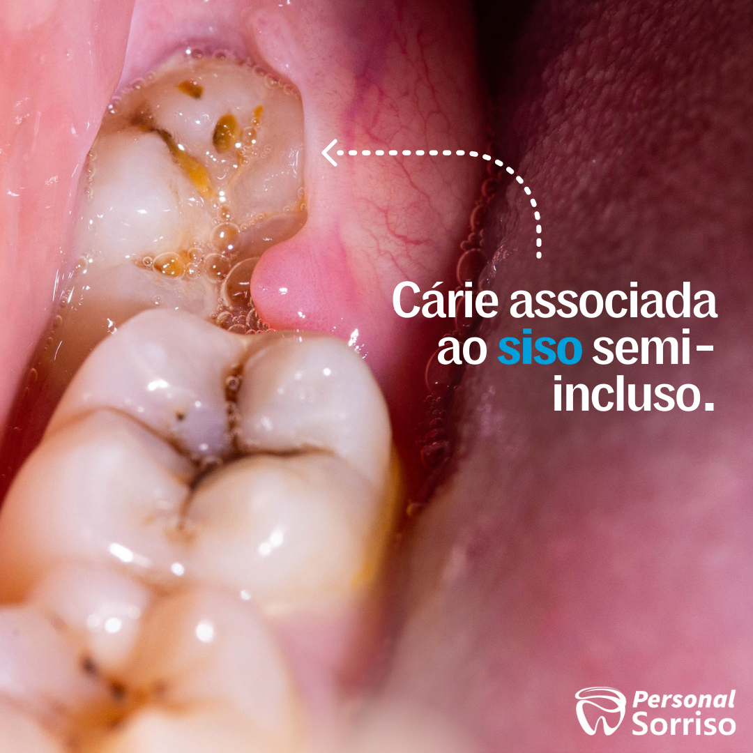 Cirurgia Dos Dentes Semi Inclusos Sisos Wanessa Paje